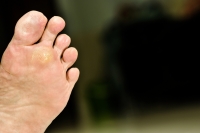 When Plantar Warts Spread