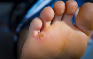 Risk Factors Associated With Foot Corns
