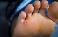 Risk Factors Associated With Foot Corns