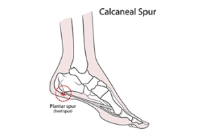 Symptoms of Heel Spurs