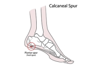 Symptoms of Heel Spurs