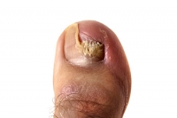 What Can Cause Toenail Fungus?