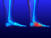 Conditions That May Cause Flat Feet in Adults
