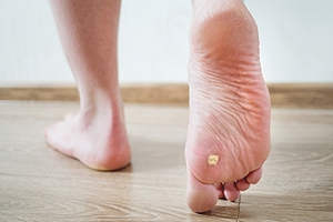 Causes of Plantar Warts