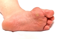 How to Manage Corns on the Feet