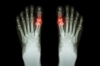 Painful Gout Attacks at Night