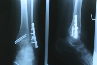 The Difference Between a Stress Fracture and a Complete Fracture